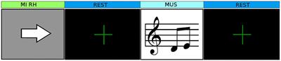 Long Multi-Stage Training for a Motor-Impaired User in a BCI Competition